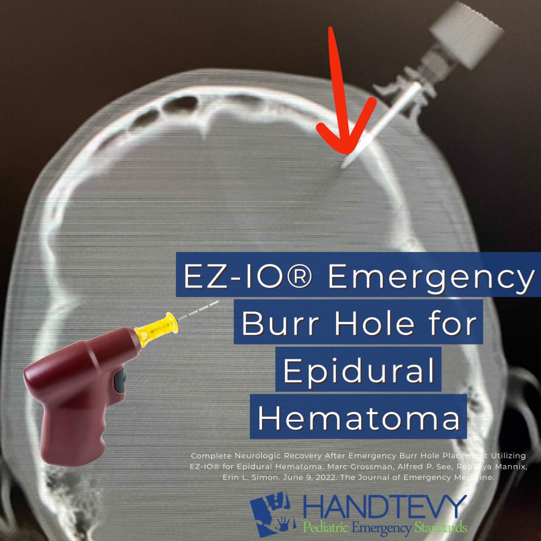 EZ-IO® Emergency Burr Hole for Epidural Hematoma